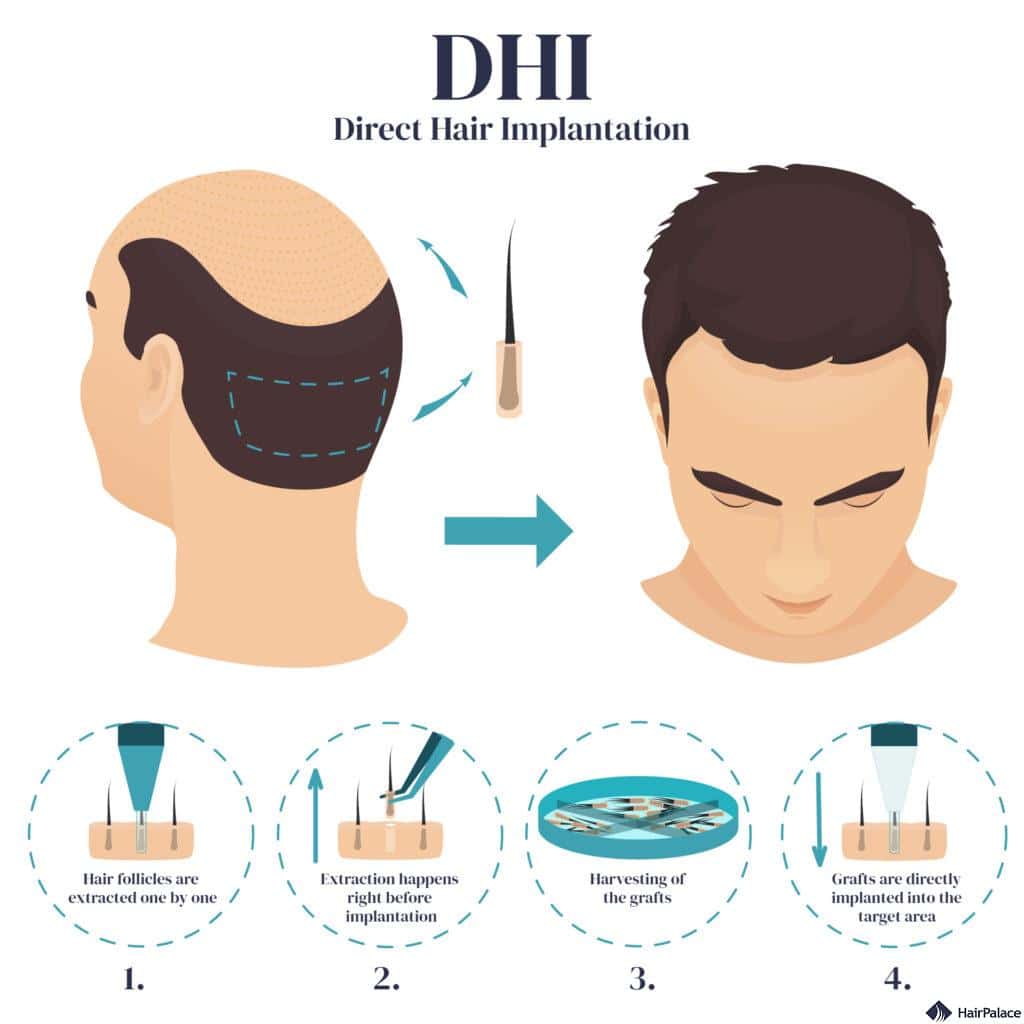 How does DHI hair transplant work?